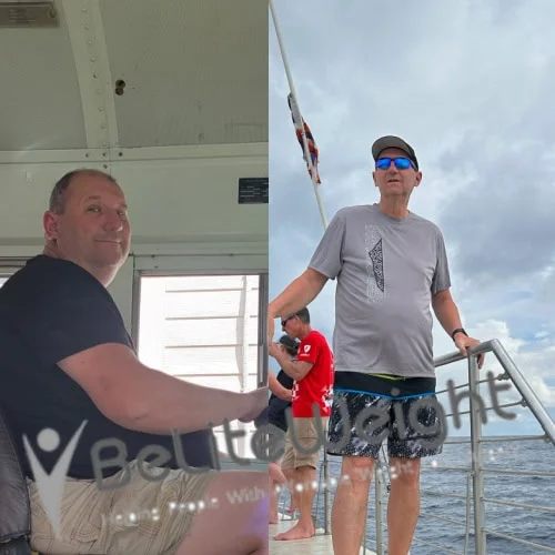 Weight Loss Surgery Gastric Sleeve before and after